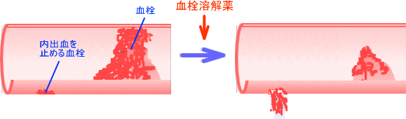 血栓溶解薬による出血
