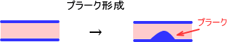 プラーク形成